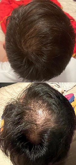 三個月療程，減低DHT，改善雄性脫髮