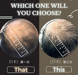 改善敏感性，壓力脫髮