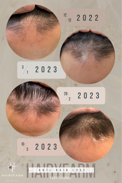 前額係最難搞嘅地方，一於選擇HairyFarm幫你搞掂佢啦